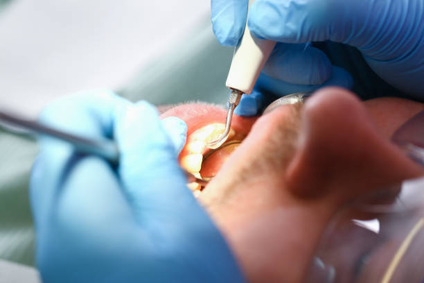 Best Emergency Dental Extractions in Hebron, IL