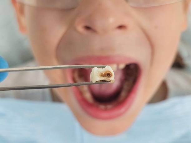 Best Emergency Root Canal Treatment in Hebron, IL